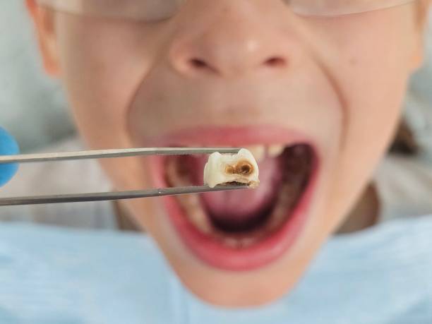 Best Emergency Tooth Extraction in Shelbyville, KY