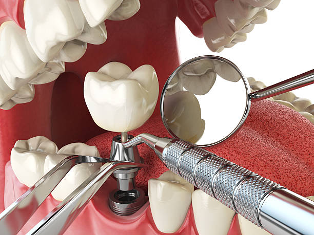 Best Emergency Root Canal Treatment in Shelbyville, KY